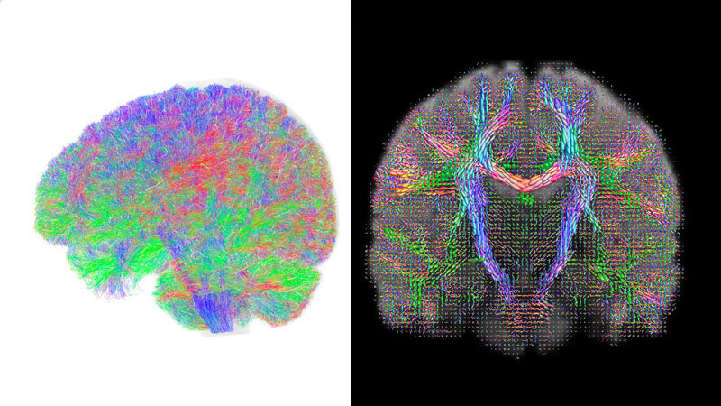 A coloured side and front brain scan image